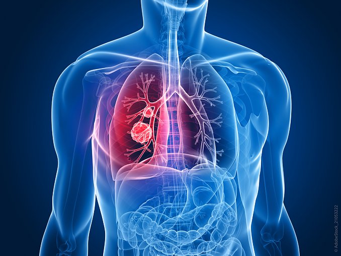 Lungenkrebs (Foto: AdobeStock)