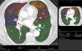 Segmentierung der Lunge mittels CAD (Foto: SHK)