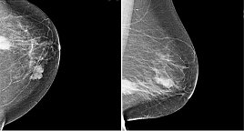 Bifokales Mammakarzinom (Foto: SHK)
