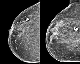 Sog. Popkornverkalkung bei Fibroadenom bei körperlich behinderter Patientin (z.n.Apoplex) (Foto: SHK)