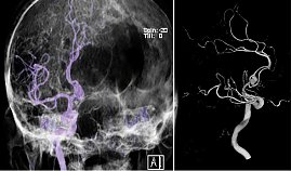 Aneurysma am ramus comm. ant. bei biplaner Panangiografie mit 3D Rekonstruktion (Foto: SHK)