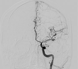Aneurysma der A. cerebri media links (Foto: SHK)