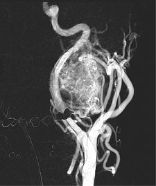Glomustumor, von der A.pharyngea asc. ausgehend (Foto: SHK)