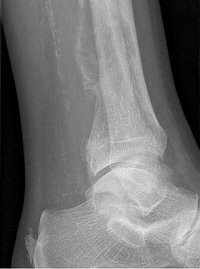 Knochenmetastase seitlich bei Peniskarzinom (Foto: SHK)