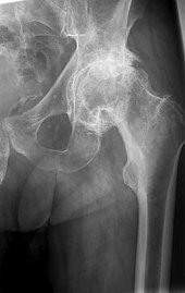 Coxarthrose Stadium 3 nach Kellgren (Foto: SHK)