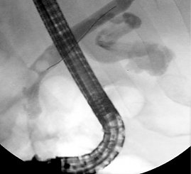 ERCP mit Choledocholithiasis (Foto: SHK)
