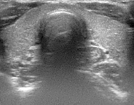 Unauff&auml;llige Schilddr&uuml;sensonografie (Foto: SHK)
