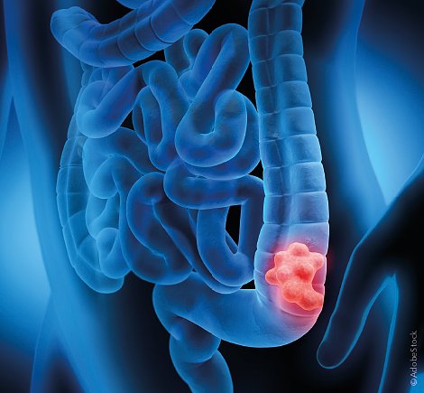 Darm (Foto: AdobeStock)