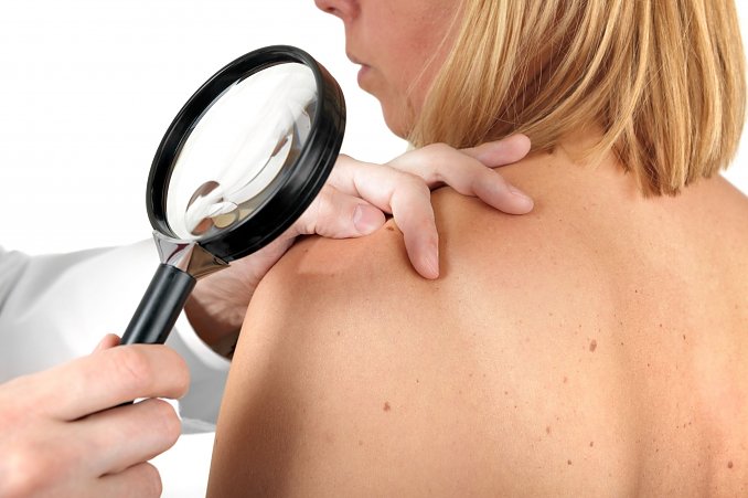 Allergie (Foto: AdobeStock) Allergie (Foto: AdobeStock)